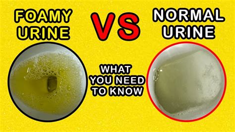 You will probably be able to go back to work or most of your usual activities in 1 or 2 days. . How long should it take for urine bubbles to disappear reddit